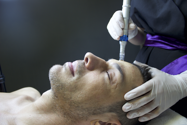 microneedling